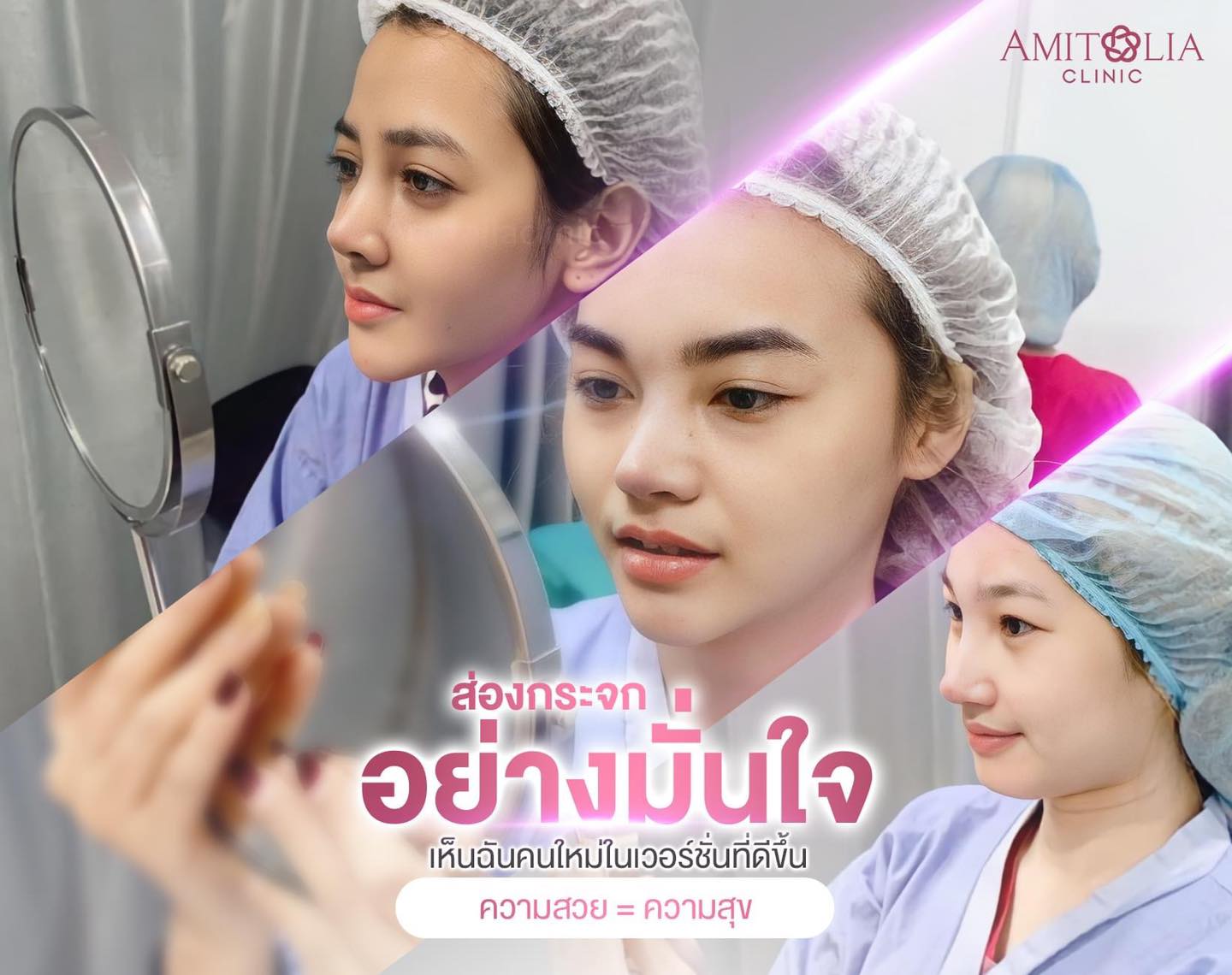 Review เสริมจมูก #126