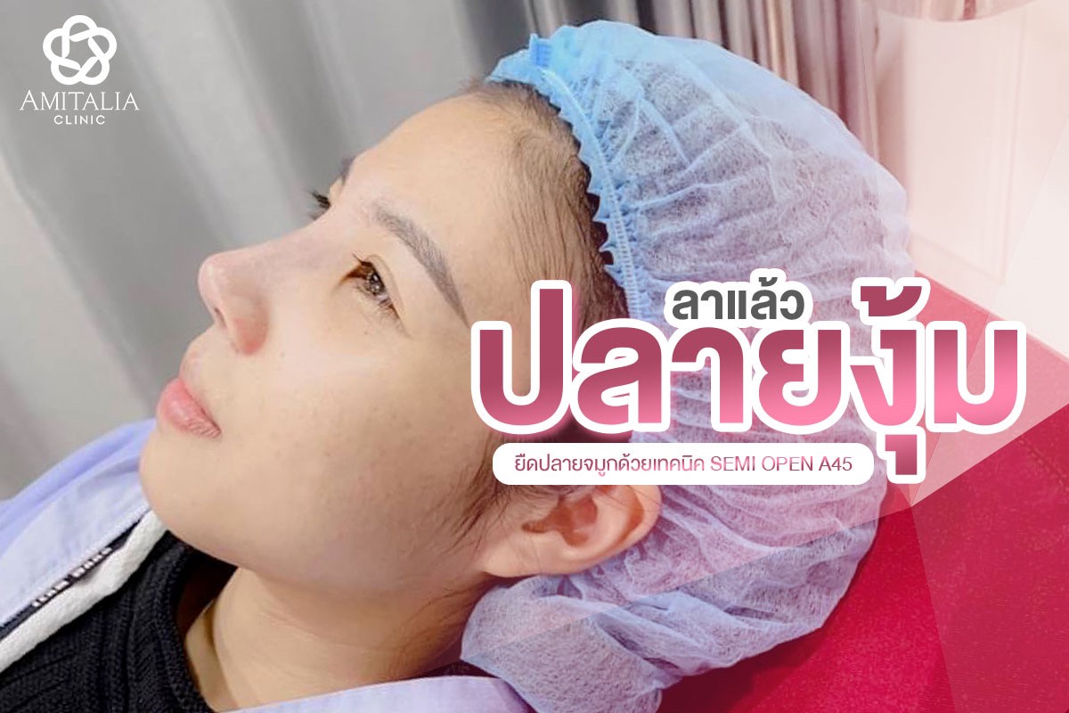 Review เสริมจมูก #90