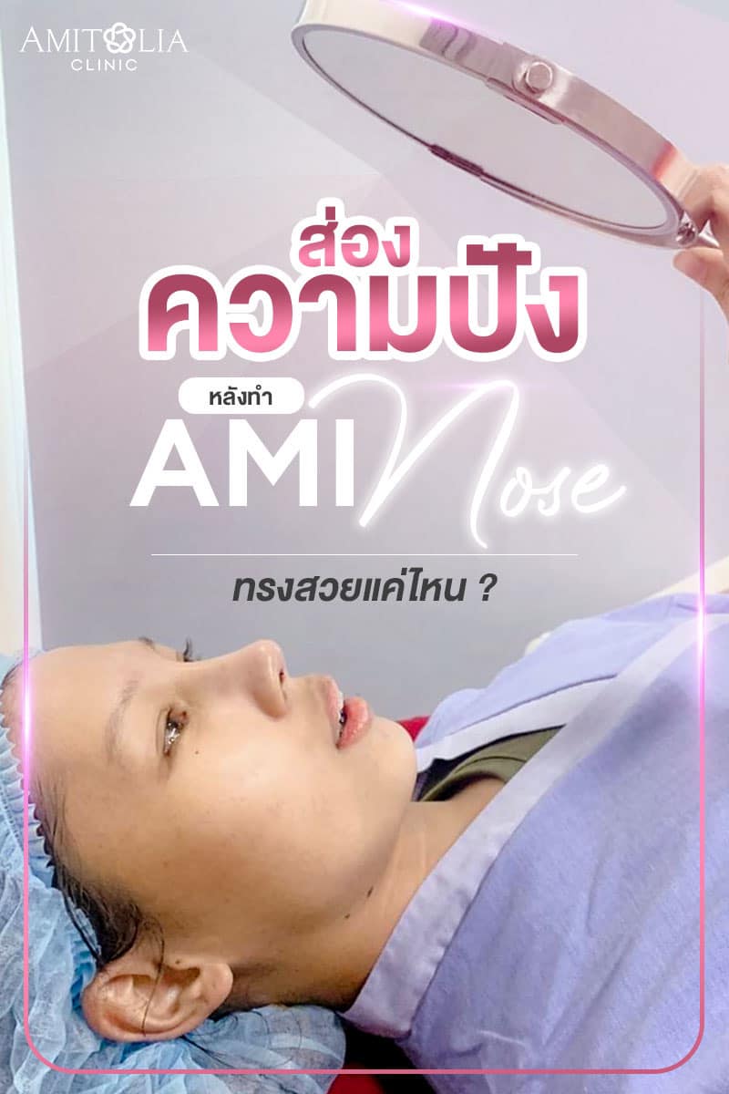 Review เสริมจมูก #94