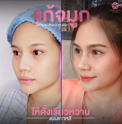 Review แก้จมูก #91