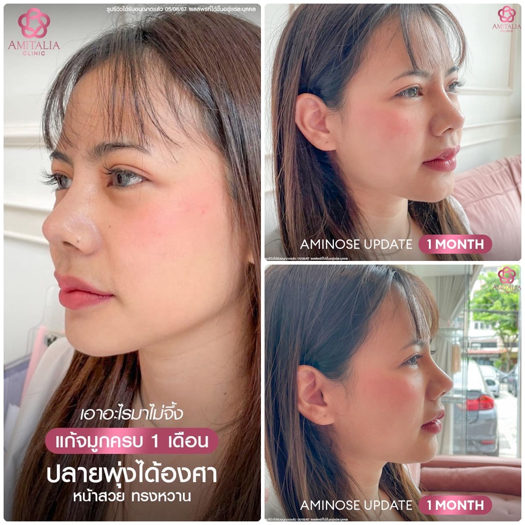 รีวิวแก้จมูกลูกสาวหน้าหวานสไตล์อมิ