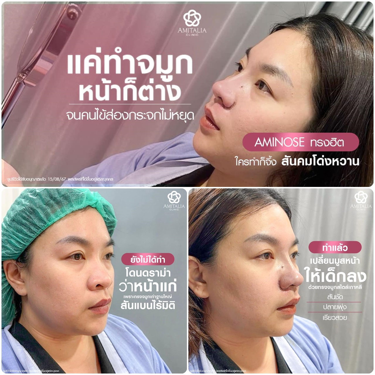 รีวิวการเสริมจมูกครั้งนี้ เปลี่ยนชีวิตมาก!