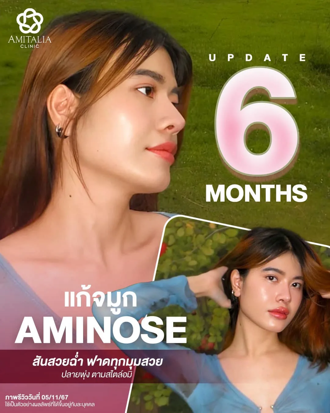 รีวิวลูกสาวอมิ แก้จมูกครบ 6 เดือน