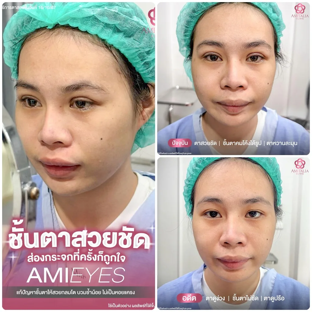 รีวิวลูกสาว งานตาสองชั้น AMIEYES