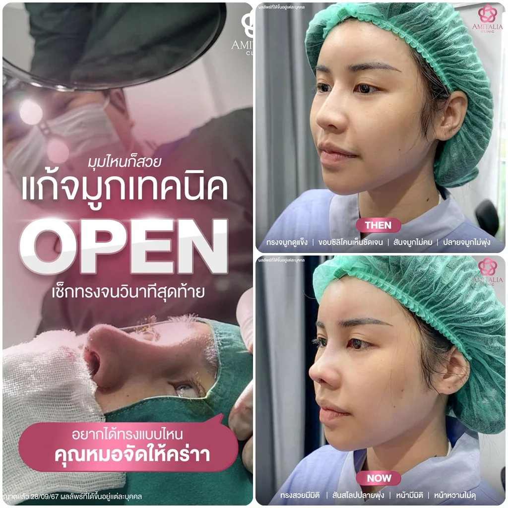 แก้จมูกด้วยเทคนิค Open