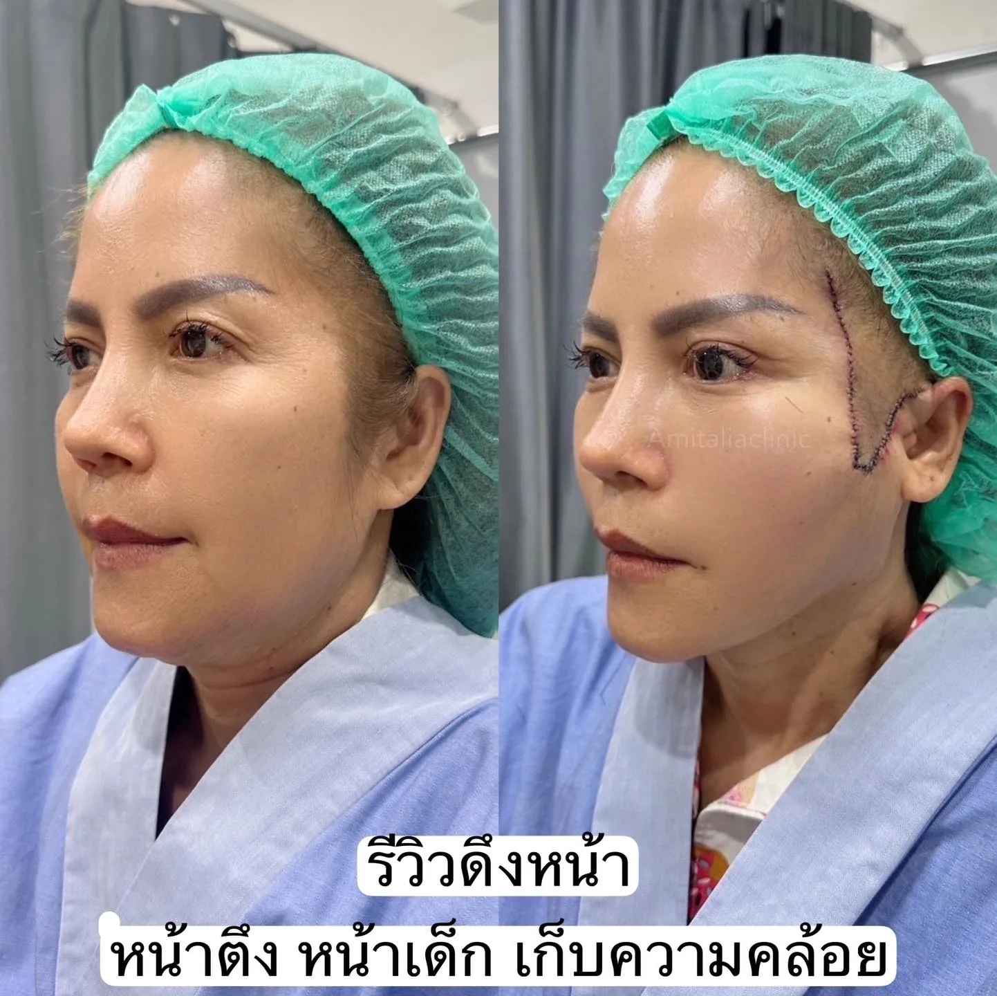 ดึงหน้าแบบ Full face เทคนิคเฉพาะปลอดภัย