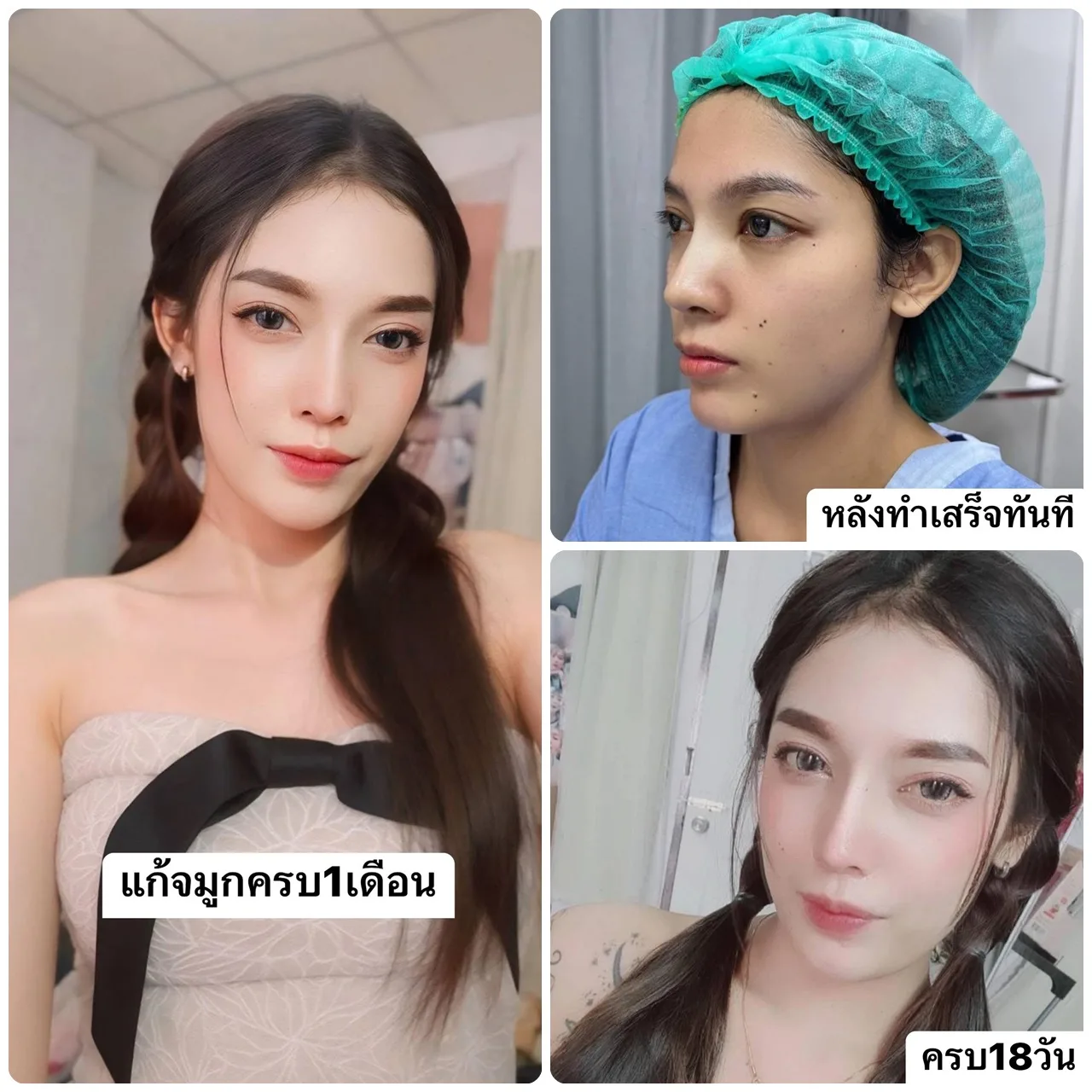 รีวิวแก้จมูก